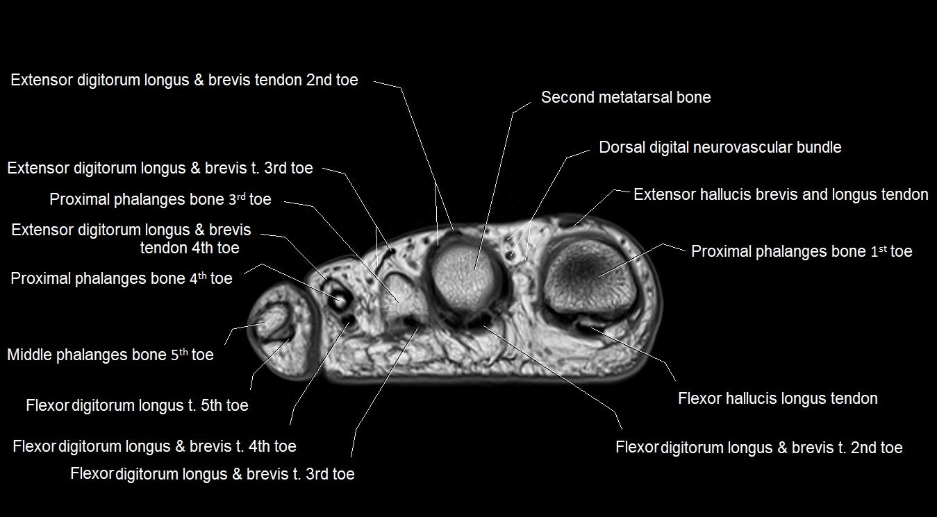 MRI 3T foot axial cross sectional anatomy image 30.webp